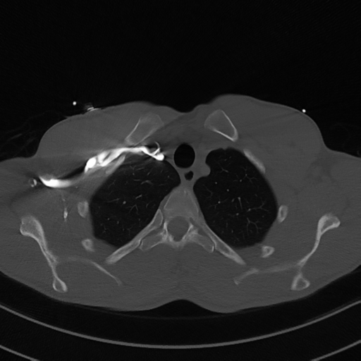 File:Cardiac tumor - undifferentiated pleomorphic sarcoma (Radiopaedia 45844-50134 Axial bone window 11).png