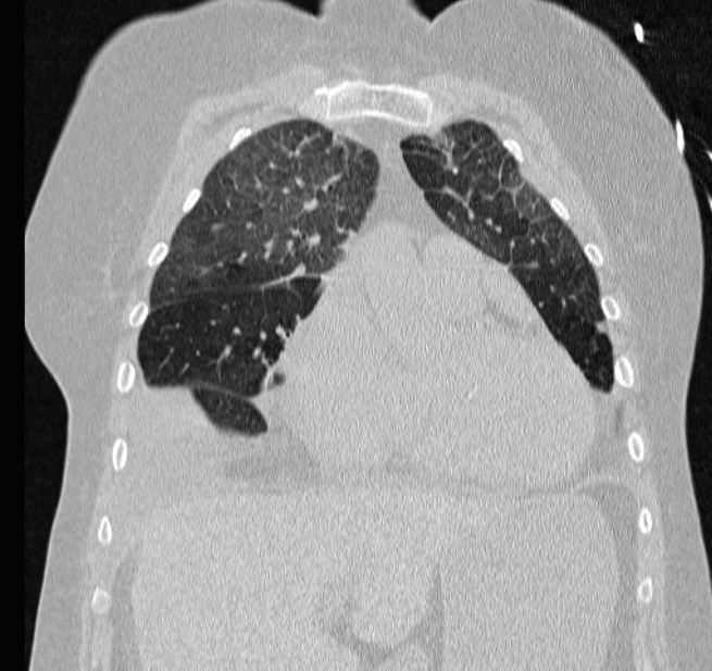 Cardiogenic pulmonary edema (Radiopaedia 29213-29609 Coronal lung window 20).jpg