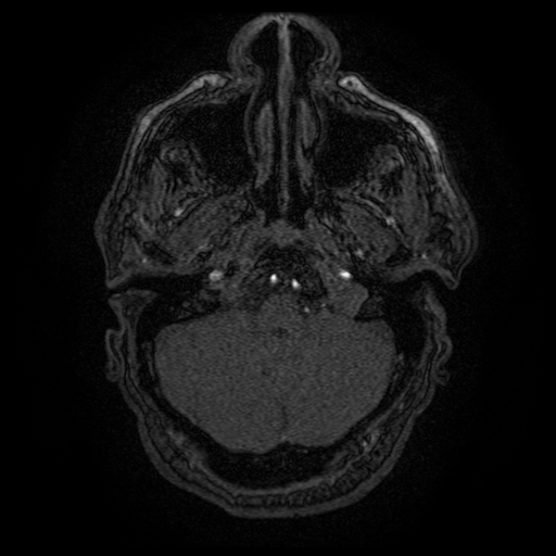 Carotid arterial dissection with acute cerebral infarction (Radiopaedia 26636-26784 MRA 147).jpg