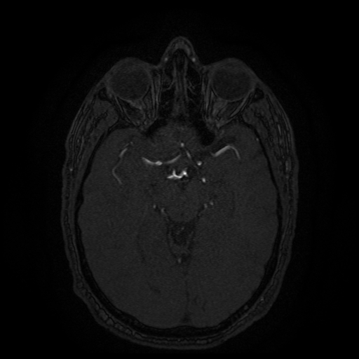 Carotid arterial dissection with acute cerebral infarction (Radiopaedia 26636-26784 MRA 95).jpg