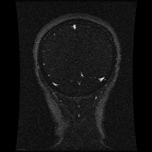 Carotid arterial dissection with acute cerebral infarction (Radiopaedia 26636-26784 MRV 51).jpg