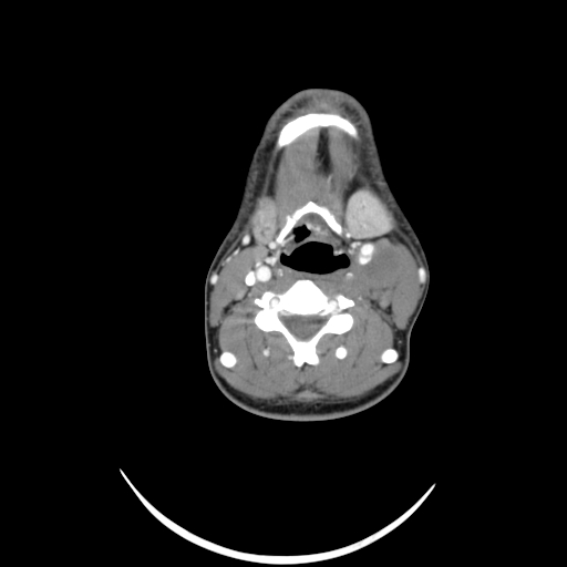 File:Carotid bulb pseudoaneurysm (Radiopaedia 57670-64616 A 37).jpg