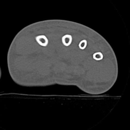 File:Carpo-metacarpal fracture-dislocations with hamatum split fracture (Radiopaedia 18482-18343 Axial bone window 6).jpg