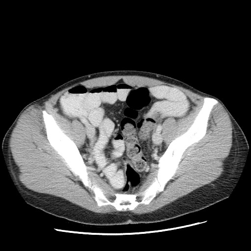 Castleman disease with fibrous pseudotumor in the abdomen (Radiopaedia 77296-89373 A 102).jpg
