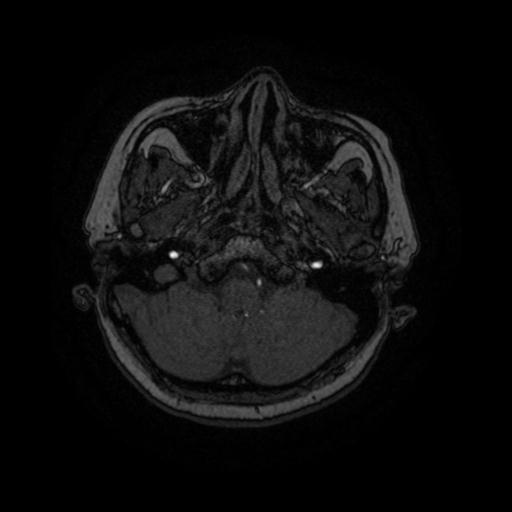 Cavernoma with developmental venous anomaly (Radiopaedia 22470-22507 MRA 83).jpg