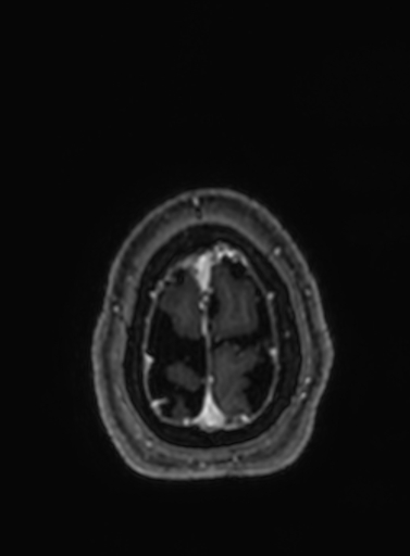 Cavernous hemangioma of the cerebellar falx (Radiopaedia 73025-83724 Axial T1 C+ 31).jpg