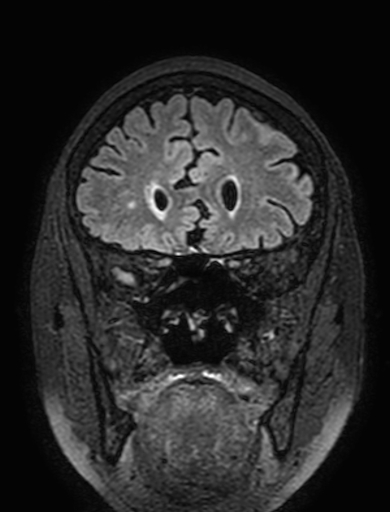 Cavernous hemangioma of the cerebellar falx (Radiopaedia 73025-83724 Coronal FLAIR 93).jpg