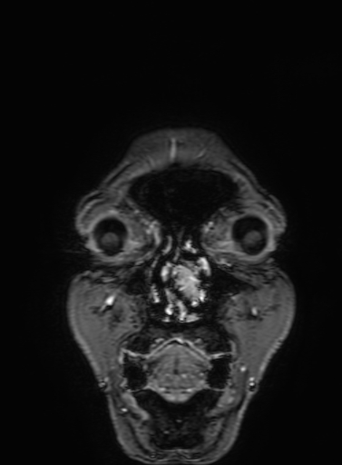 Cavernous hemangioma of the cerebellar falx (Radiopaedia 73025-83724 Coronal T1 C+ 18).jpg
