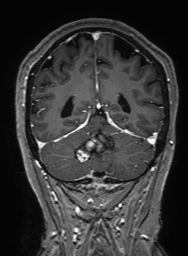 Cavernous hemangioma of the cerebellar falx (Radiopaedia 73025-83724 Coronal T1 C+ 279).jpg