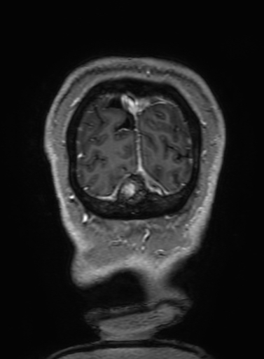 Cavernous hemangioma of the cerebellar falx (Radiopaedia 73025-83724 Coronal T1 C+ 352).jpg