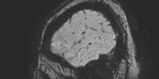 Cavernous hemangioma of the cerebellar falx (Radiopaedia 73025-83724 Sagittal BOLD 19).jpg