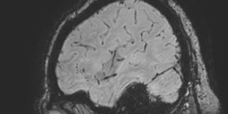 Cavernous hemangioma of the cerebellar falx (Radiopaedia 73025-83724 Sagittal BOLD 34).jpg