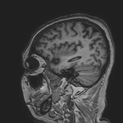 File:Cavernous hemangioma of the cerebellar falx (Radiopaedia 73025-83724 Sagittal T1 54).jpg