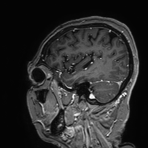 Cavernous hemangioma of the cerebellar falx (Radiopaedia 73025-83724 Sagittal T1 C+ 163).jpg