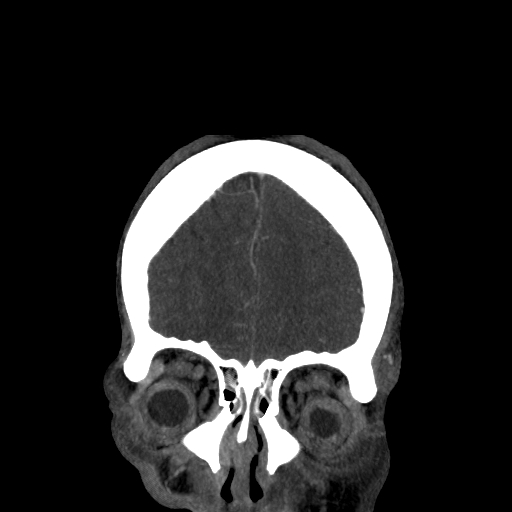 File:Cavernous sinus thrombosis (Radiopaedia 10619-11078 D 1).jpg