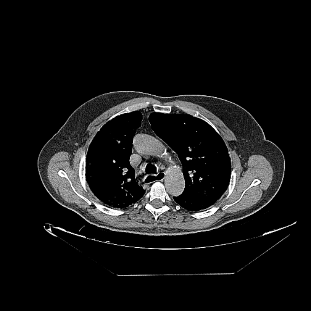 Cavitating bronchogenic carcinoma (Radiopaedia 44489-48162 Axial non-contrast 27).jpg
