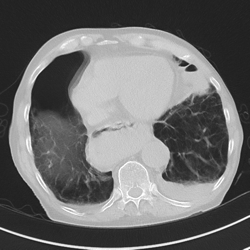 Cavitating pneumonia - lingular segments (Radiopaedia 34386-35678 Axial lung window 46).png