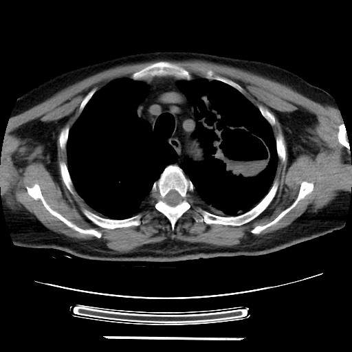 Cavitating pulmonary metastases (Radiopaedia 89545-106544 Axial non-contrast 13).jpg