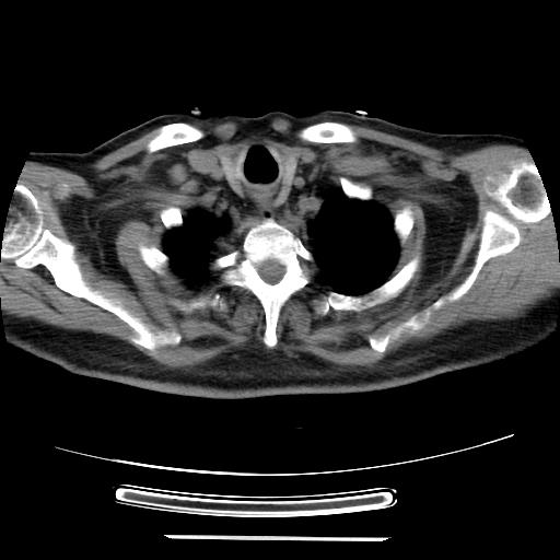 File:Cavitating pulmonary metastases (Radiopaedia 89545-106544 Axial non-contrast 4).jpg