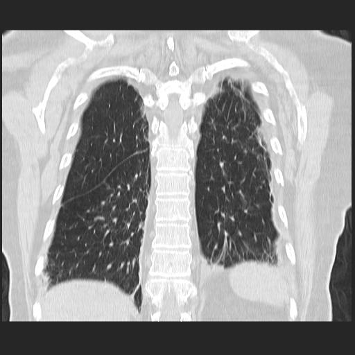 File:Cavitating pulmonary metastases (Radiopaedia 89545-106544 Coronal lung window 35).jpg