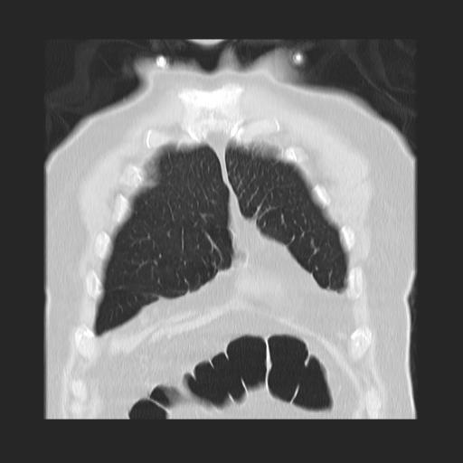 File:Cavitating pulmonary metastases (Radiopaedia 89545-106544 Coronal lung window 7).jpg
