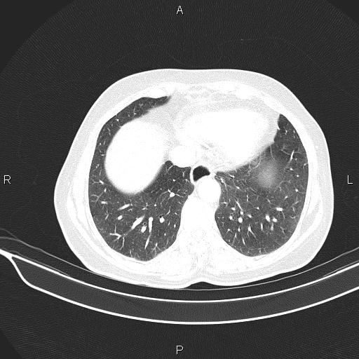 Cecal cancer (Radiopaedia 85610-101358 Axial lung window 49).jpg