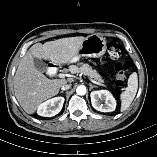 Cecal cancer with appendiceal mucocele (Radiopaedia 91080-108651 A 69).jpg