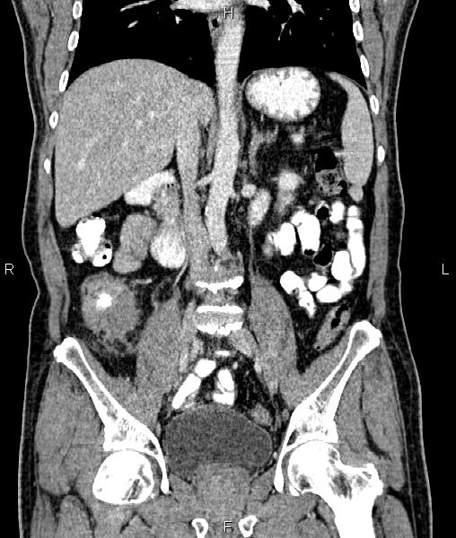 Cecal cancer with appendiceal mucocele (Radiopaedia 91080-108651 D 41).jpg