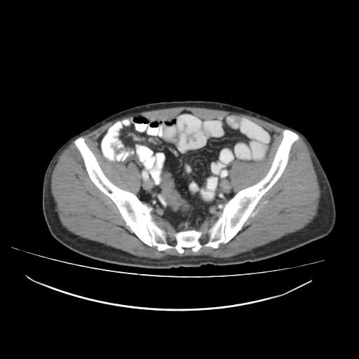 Cecal carcinoma with local lymphadenopathy (Radiopaedia 31428-32240 A 42).jpg