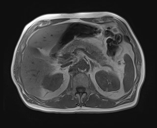 File:Cecal mass causing appendicitis (Radiopaedia 59207-66532 Axial T1 in-phase 46).jpg