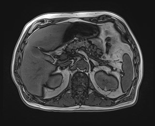 Cecal mass causing appendicitis (Radiopaedia 59207-66532 D 44).jpg