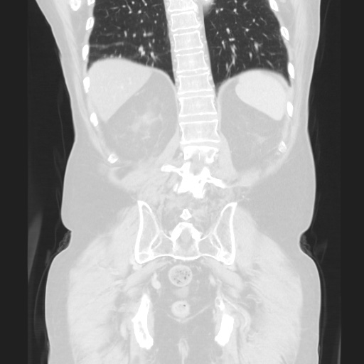 Cecal volvulus (Radiopaedia 75378-86620 Coronal lung window 105).jpg