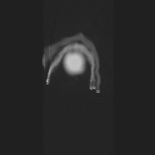 Cecal volvulus (Radiopaedia 75378-86620 Coronal lung window 3).jpg