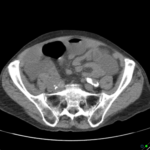 Cecal volvulus - atypical (Radiopaedia 21637-21588 non-contrast 52).jpg