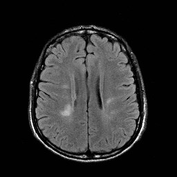 File:Central-variant posterior reversible encephalopathy syndrome (PRES) (Radiopaedia 43880-47358 Axial FLAIR 16).jpg