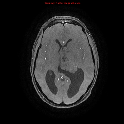 Central neurocytoma (Radiopaedia 13188-13206 Axial MRA 48).jpg