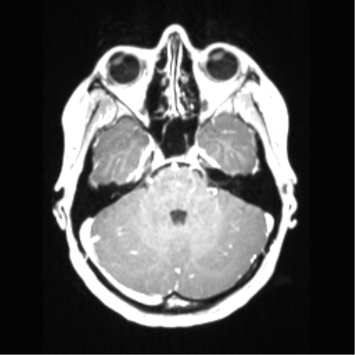 File:Central neurocytoma (Radiopaedia 37664-39557 Axial T1 C+ 24).png
