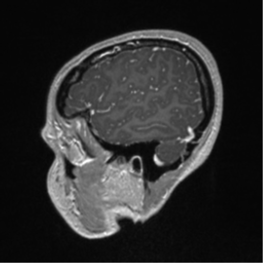 Central neurocytoma (Radiopaedia 37664-39557 Sagittal T1 C+ 18).png