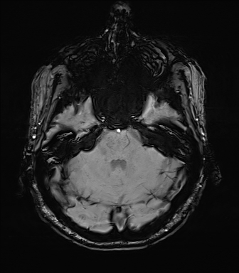 File:Central neurocytoma (Radiopaedia 71068-81303 Axial SWI 13).jpg