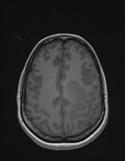 Central neurocytoma (Radiopaedia 84497-99872 Axial T1 143).jpg
