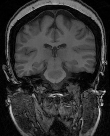 File:Central pontine myelinolysis (Radiopaedia 11286-11650 Coronal 1).jpg