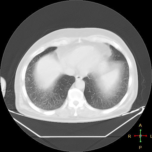 File:Centrilobular emphysema - with superimposed infection (Radiopaedia 24389-24683 lung window 23).jpg