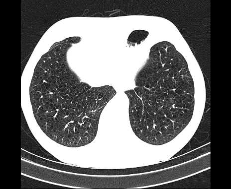 Centrilobular pulmonary emphysema (Radiopaedia 62468-70718 Axial lung window 64).jpg