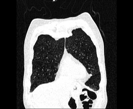 Centrilobular pulmonary emphysema (Radiopaedia 62468-70718 Coronal lung window 14).jpg