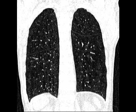 Centrilobular pulmonary emphysema (Radiopaedia 62468-70718 Coronal lung window 56).jpg