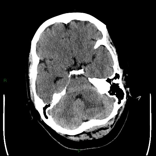 Cerebellar abscess (Radiopaedia 78135-90671 Axial non-contrast 33).jpg