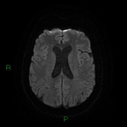 File:Cerebellar abscess (Radiopaedia 78135-90678 Axial DWI 19).jpg