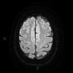 Cerebellar abscess (Radiopaedia 78135-90678 Axial DWI 23).jpg