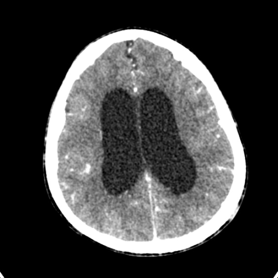 Cerebellar abscess secondary to mastoiditis (Radiopaedia 26284-26412 Axial C+ delayed 105).jpg