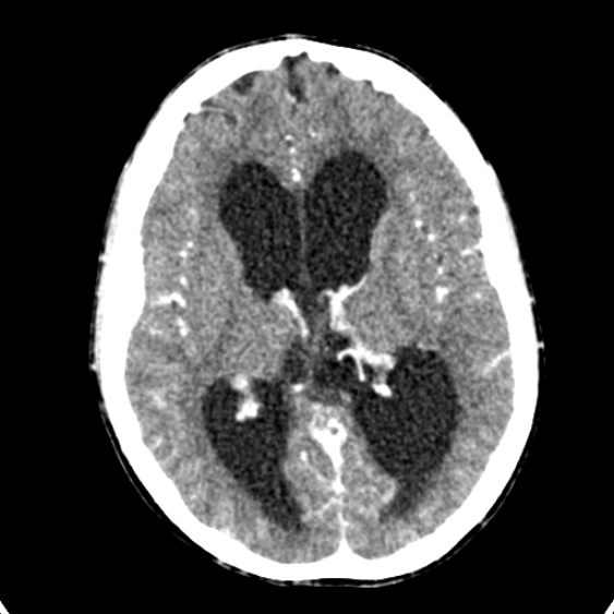 Cerebellar abscess secondary to mastoiditis (Radiopaedia 26284-26412 Axial C+ delayed 83).jpg
